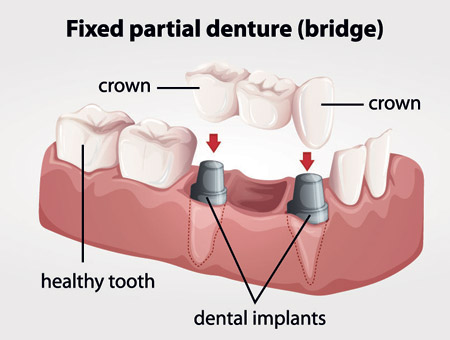 Dental bridge