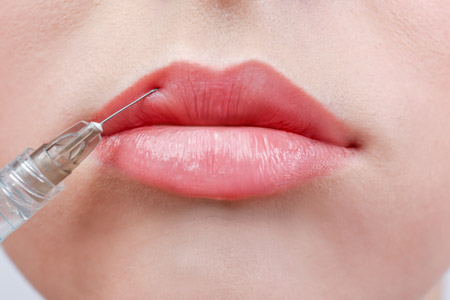 Dermal filler treatment