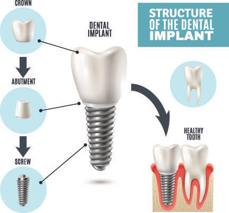 Dental implant procedure illustration