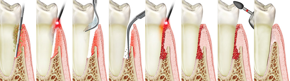 Laser gum surgery