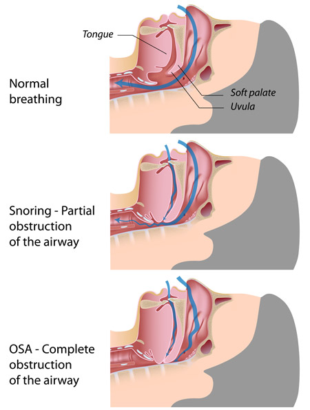 Obstructive sleep apnea
