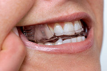 Oral appliance therapy for sleep apnea