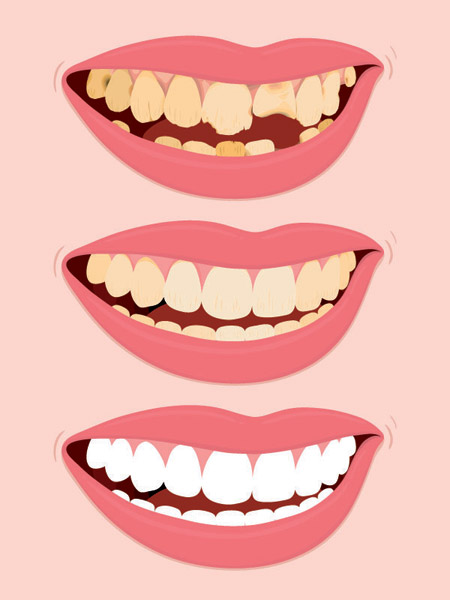 Tooth recontouring