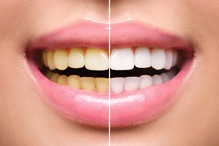 Teeth whitening